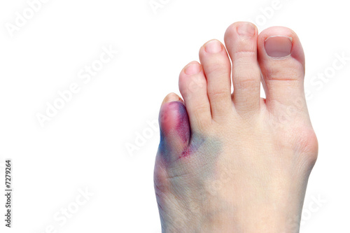 Photo: Bruises, bunions and broken toes Bruises, bunions and broken toes