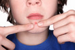 Picking at a Pimple