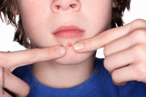 Photo: Picking at a Pimple Picking at a Pimple