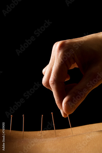 Acupuncture