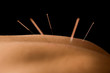 Acupuncture