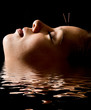 Acupuncture Acupuncture