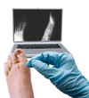 Foot surgery