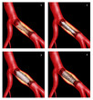 stent coronarico