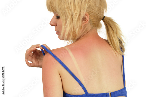 Photo: Sunburn Sunburn