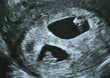 Echographie jumeaux grossesse