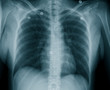 Female Chest X Ray