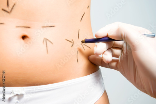 Photo: Marking abdomen for cosmetic correction surgery Marking abdomen for cosmetic correction surgery