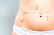Marks on abdomen for cosmetic surgery Marks on abdomen for cosmetic surgery
