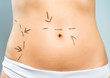 Marked abdomen for cosmetic surgery