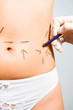 Marks for plastic surgery
