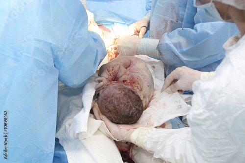 Baby Born on Photo  New Baby Being Born During Cesarean Section    Leonid Shcheglov