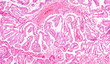 Thyroid Gland Cancer