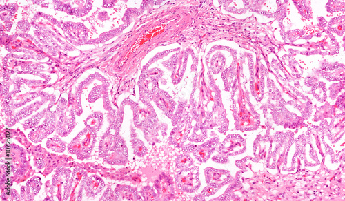 Photo: Thyroid Gland Cancer Thyroid Gland Cancer
