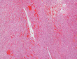 Angiosarcoma micrograph