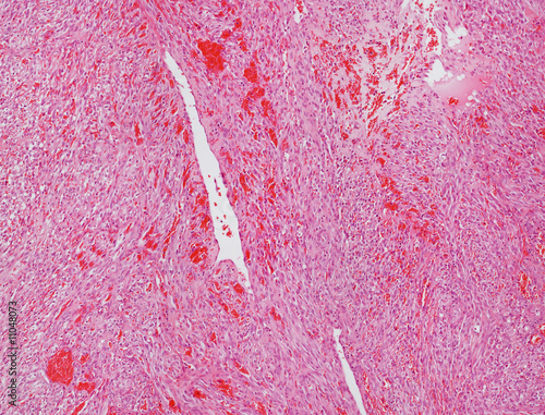Angiosarcoma micrograph