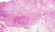 Stomach cancer micrograph