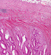 Bowel Cancer