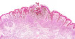 Malignant Melanoma Microscope Picture