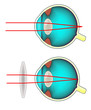 Longsighted eye corrected with a convex lens