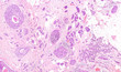 Breast cancer microscope picture