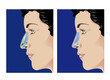 rhinoplasty