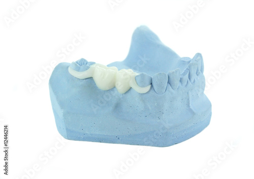 Photo: Thermoflex - A unilater partial bridge Thermoflex - A unilater partial bridge