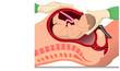 Kaiserschnitt abdominal caesarean section Geburt Baby
