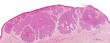 Basal-cell carcinoma