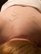 acupuncture