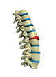 Spine with deformed spinal disc