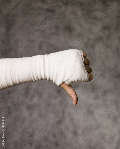 Photo: Thumbs down from injured hand Thumbs down from injured hand