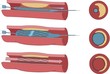 stent