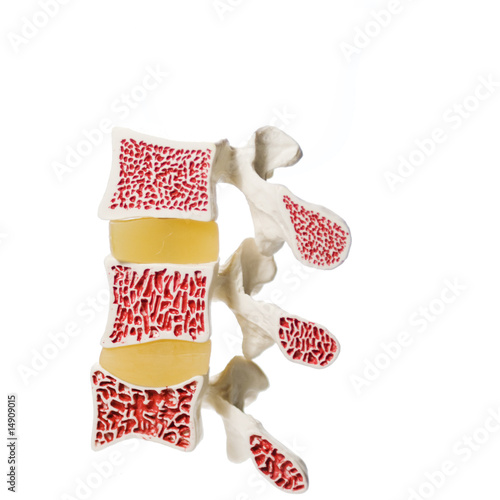 Photo: Artificial model of the stages of osteoporosis. Artificial model of the stages of osteoporosis.