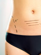 Marked abdomen for plastic surgery Marked abdomen for plastic surgery