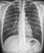 Chest X-Ray PA view