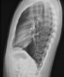 Chest X-Ray lateral view Chest X-Ray lateral view