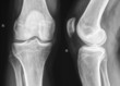 Right knee X-Ray