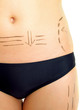 ..Marks on abdomen and thigh for cosmetic surgery ..Marks on abdomen and thigh for cosmetic surgery