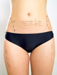Abdomen, waist, thigh marked for plastic surgery Abdomen, waist, thigh marked for plastic surgery