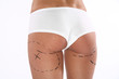 Fesses chirurgie esthetique