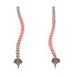 thoracic and lumbar scoliosis