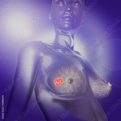 Illustration: Brustkrebs Brustkrebs