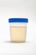 Urine sample in plastic pot
