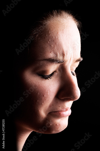 Photo: Depressed female acne sufferer Depressed female acne sufferer