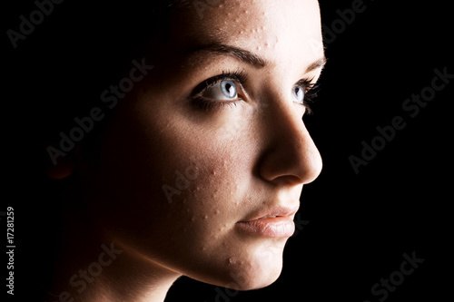 Photo: Female acne sufferer Female acne sufferer