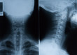 X-Ray film of neck - front and side X-Ray film of neck - front and side