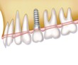 implantation (white)