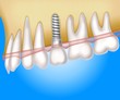 implantation (blue)