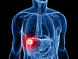 transparenter Körper mit Lebertumor transparenter Körper mit Lebertumor